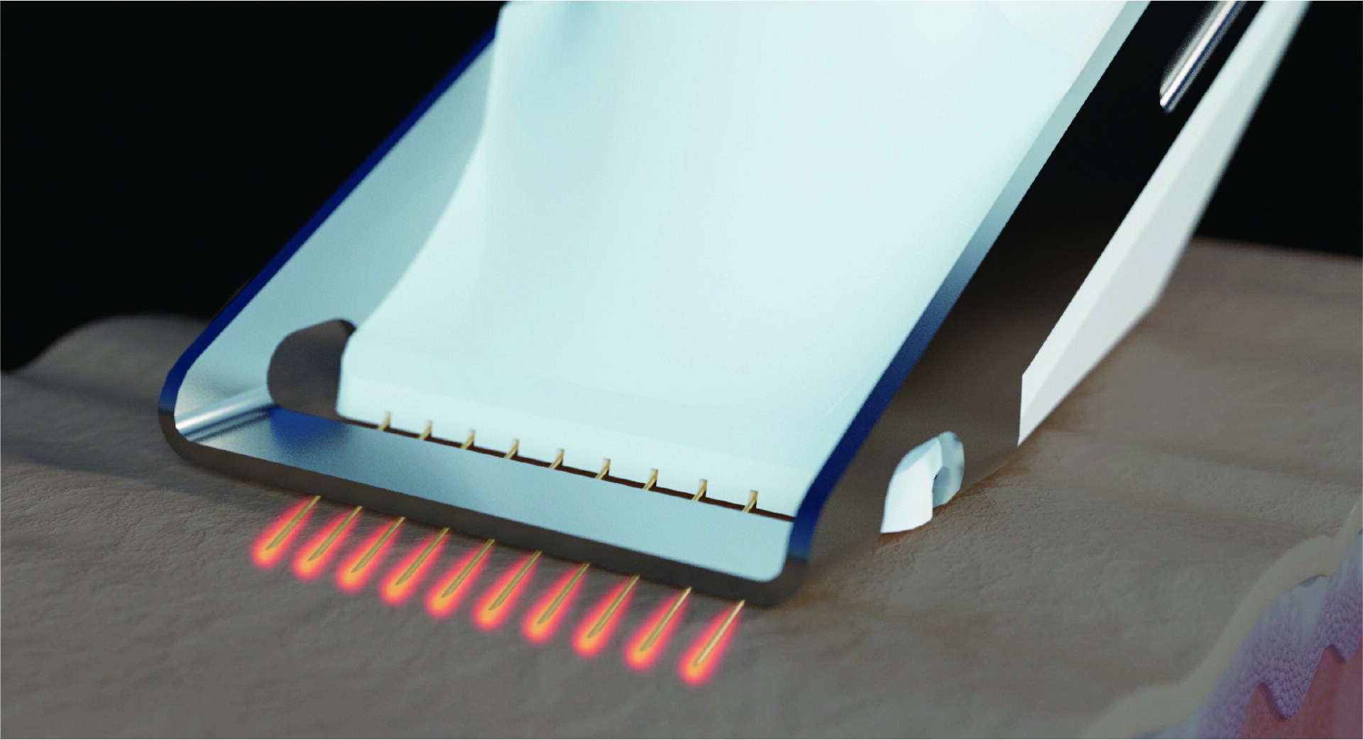 ブレッシング   高周波（RF）＋傾斜ニードル＋薬剤導入の特徴