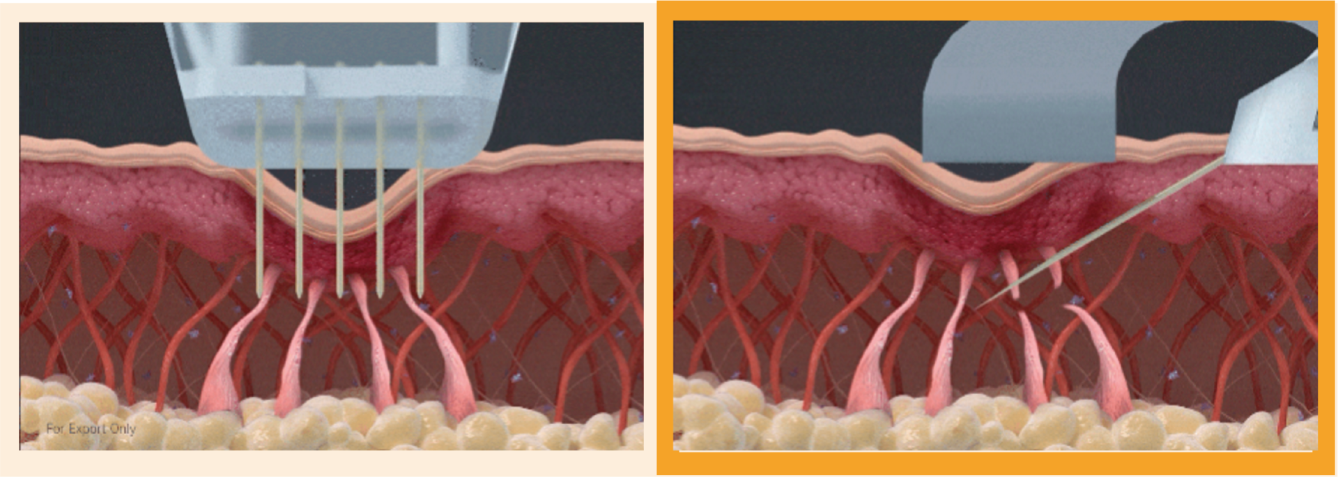 ブレッシング   高周波（RF）＋傾斜ニードル＋薬剤導入の特徴