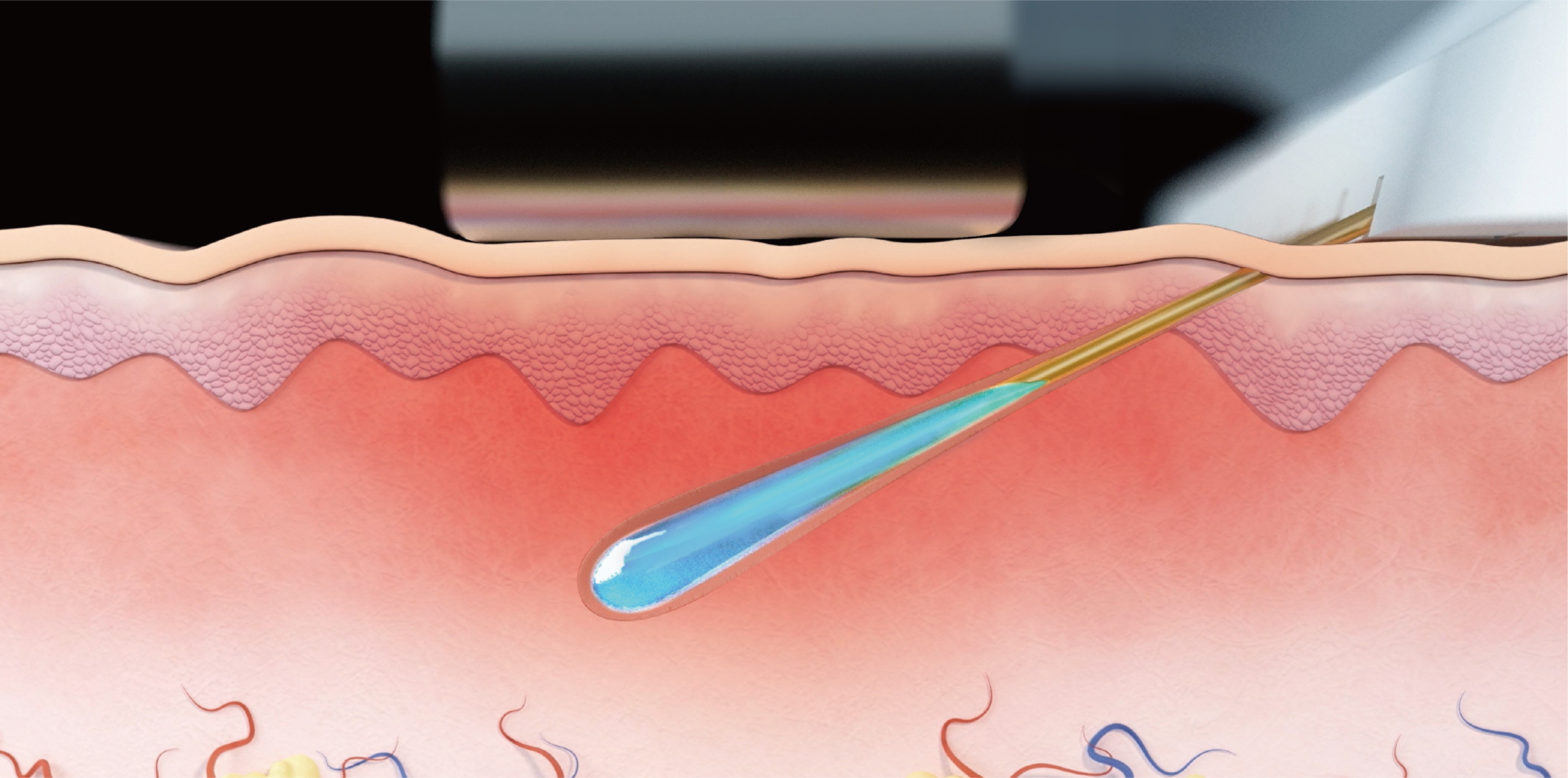 ブレッシング   高周波（RF）＋傾斜ニードル＋薬剤導入の特徴